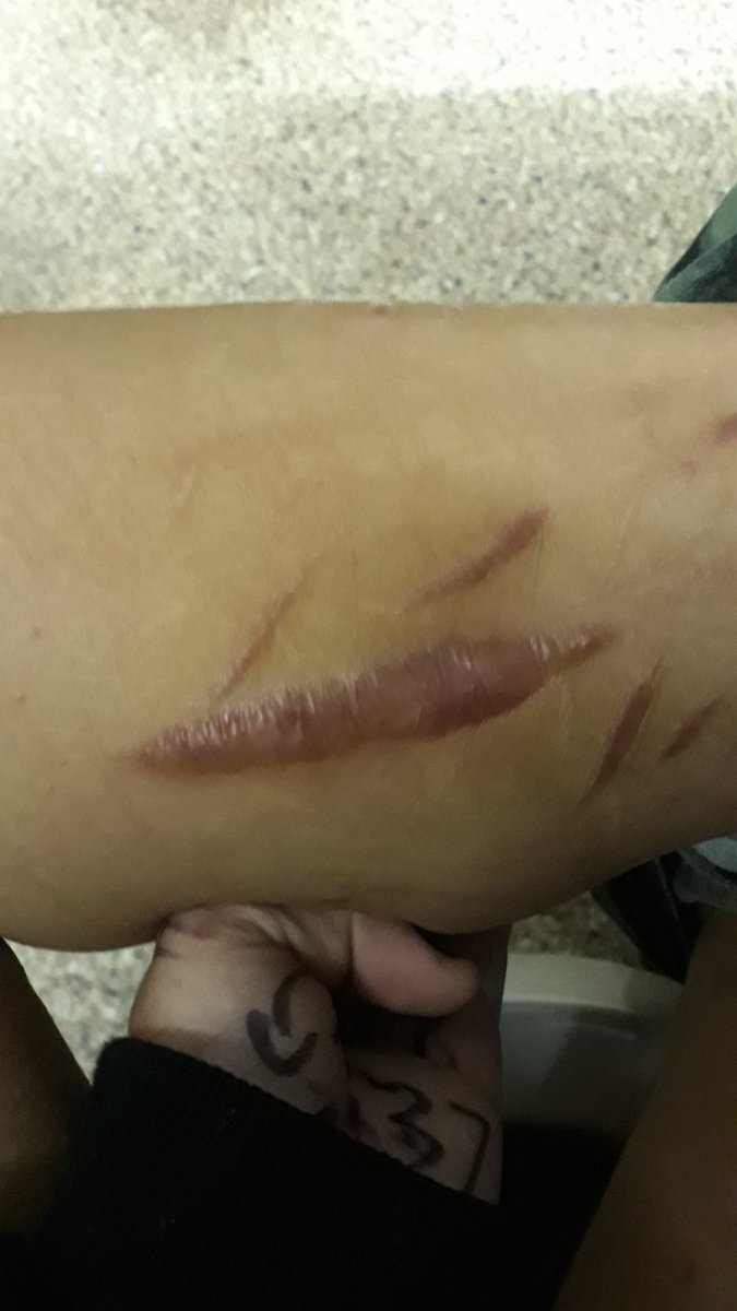 Zero28145304's tweet photo. Scars ♡♡♡
Shtwt 988twt yellowspongetwt beanstwt styrotwt https://t.co/vomcWzRnCx