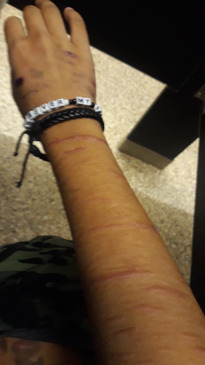 Zero28145304's tweet photo. Scars ♡♡♡
Shtwt 988twt yellowspongetwt beanstwt styrotwt https://t.co/vomcWzRnCx