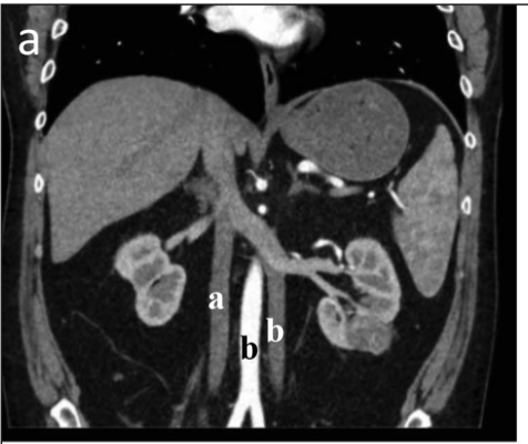 Mark Ball, MD, FACS (@markballmd) on Twitter photo Nice case series and review on #kidneysurgery in patients with duplicated IVC from <a href="/ChrisPDall/">Christopher Dall</a> <a href="/GUUrology/">Georgetown University Urology</a> in <a href="/canjurol/">Canadian J Urology</a>. Crazy we had two cases during his @NCICCR_UroOnc rotation!
pubmed.ncbi.nlm.nih.gov/36495583/ Nice case series and review on #kidneysurgery in patients with duplicated IVC from <a href="/ChrisPDall/">Christopher Dall</a> <a href="/GUUrology/">Georgetown University Urology</a> in <a href="/canjurol/">Canadian J Urology</a>. Crazy we had two cases during his @NCICCR_UroOnc rotation!
pubmed.ncbi.nlm.nih.gov/36495583/
