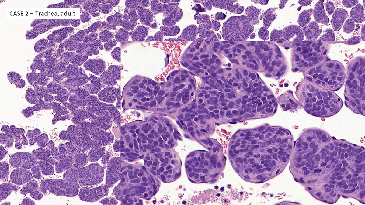 TristanRutland7's tweet photo. ❗️Quiz time❗️

➡️Cases with 6 questions.

❓Question 1.

✒️Which of the following tumours is most likely to have a ss18-ssx rearrangement  translocation?

#BSTpath #Gynpath #Pulmpath #Pathtwitter #pathresidents https://t.co/SvTb6ePJi7
