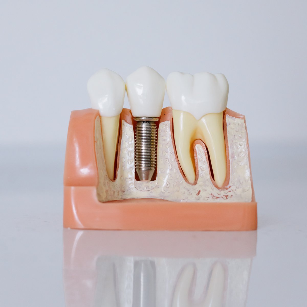 What is involved in dental implants? Often the day the tooth is removed  and a bone graft is placed to fill the hole left behind. 

Designs in Ortho- NKY
designsinortho.com
#custommouthguard
#athleticmouthguard