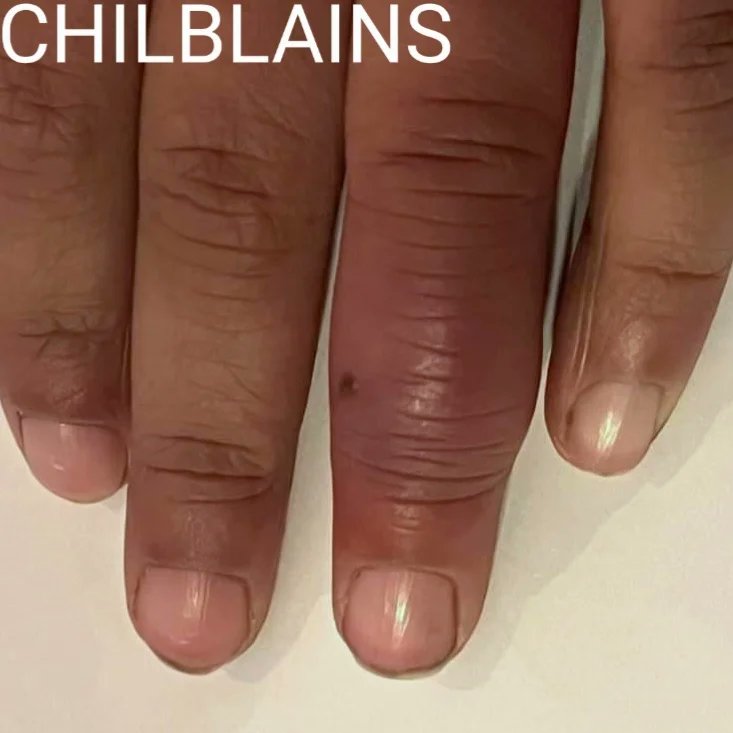 Chilblains is an inflammation of the vessels in the hands and feet caused by exposure to cold. Swelling of the affected fingers or toes may result (see ring finger in photo), with itchy/sore patches and blisters. The reddening may be subtle, especially on darker skin. #MedTwitter