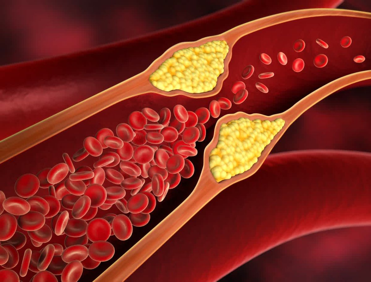 MedwebL's tweet photo. MedWeb Blog of the day ☀️

Combo Of Bad Cholesterol And High Blood Pressure ⬆️🩸 May Increase Heart Attack Or Stroke Risk

High levels of lipoprotein(a), a type of "bad" cholesterol, may...

Read full: https://t.co/iEIKTuNukM

#thrombosis #heartattack #stroke #cholesterol #Blog https://t.co/enI2FdCzRG