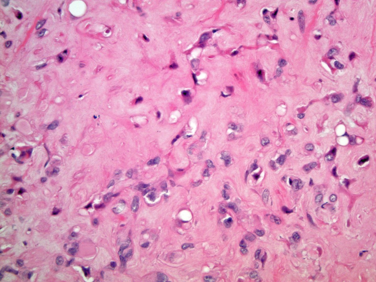 Scott Kilpatrick, MD (@scottbikeethan) on Twitter photo Ready to play match the fusion with the vascular lesion? Bonus if you can also name the tumor! Dare I say chromosomes, for the older folks? <a href="/sm_armstrong8/">Susan Armstrong</a> <a href="/CCFPathRes/">Cleveland Clinic Pathology Residency</a> <a href="/CLEClinicLabs/">ClevelandClinicLabs</a> <a href="/ahmed_bakhshwin/">Ahmed Bakhshwin</a> <a href="/JosephineKTD/">Josephine</a>
1. SERPINE1::FOSB
2. FOS::LMNA
3. WWTR1::CAMTA1
4. PTBP1::MAML2 Ready to play match the fusion with the vascular lesion? Bonus if you can also name the tumor! Dare I say chromosomes, for the older folks? <a href="/sm_armstrong8/">Susan Armstrong</a> <a href="/CCFPathRes/">Cleveland Clinic Pathology Residency</a> <a href="/CLEClinicLabs/">ClevelandClinicLabs</a> <a href="/ahmed_bakhshwin/">Ahmed Bakhshwin</a> <a href="/JosephineKTD/">Josephine</a>
1. SERPINE1::FOSB
2. FOS::LMNA
3. WWTR1::CAMTA1
4. PTBP1::MAML2