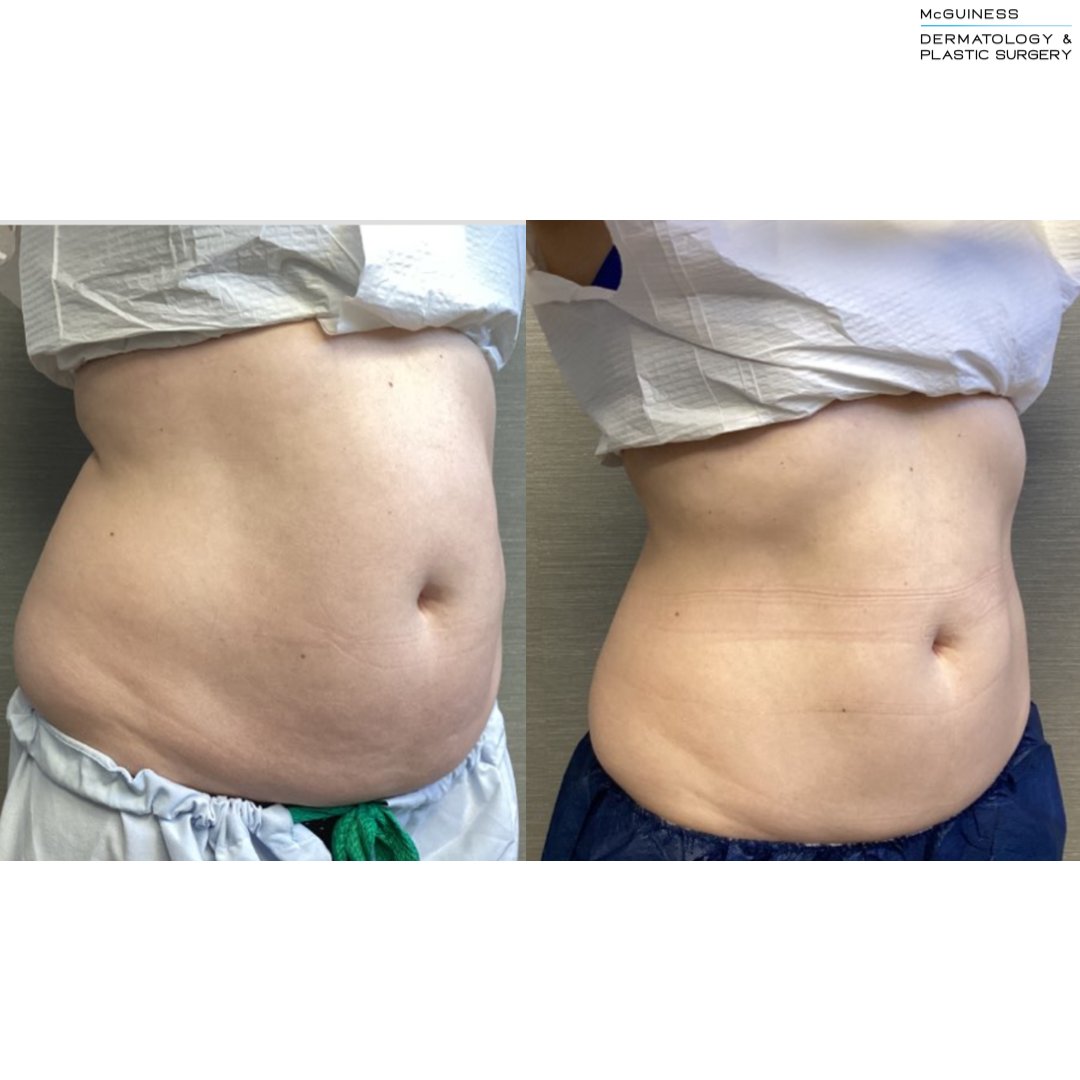 McGuinessDerm's tweet photo. Winter is the perfect time to start your CoolSculpting treatment because in 3 months you’ll see your full results 🤩 CoolSculpting freezes fat cells and then naturally eliminates them, resulting in a 20-25% reduction of fat in the treated areas. 

This patient was treated by  ... https://t.co/7Tf9uTXDI1