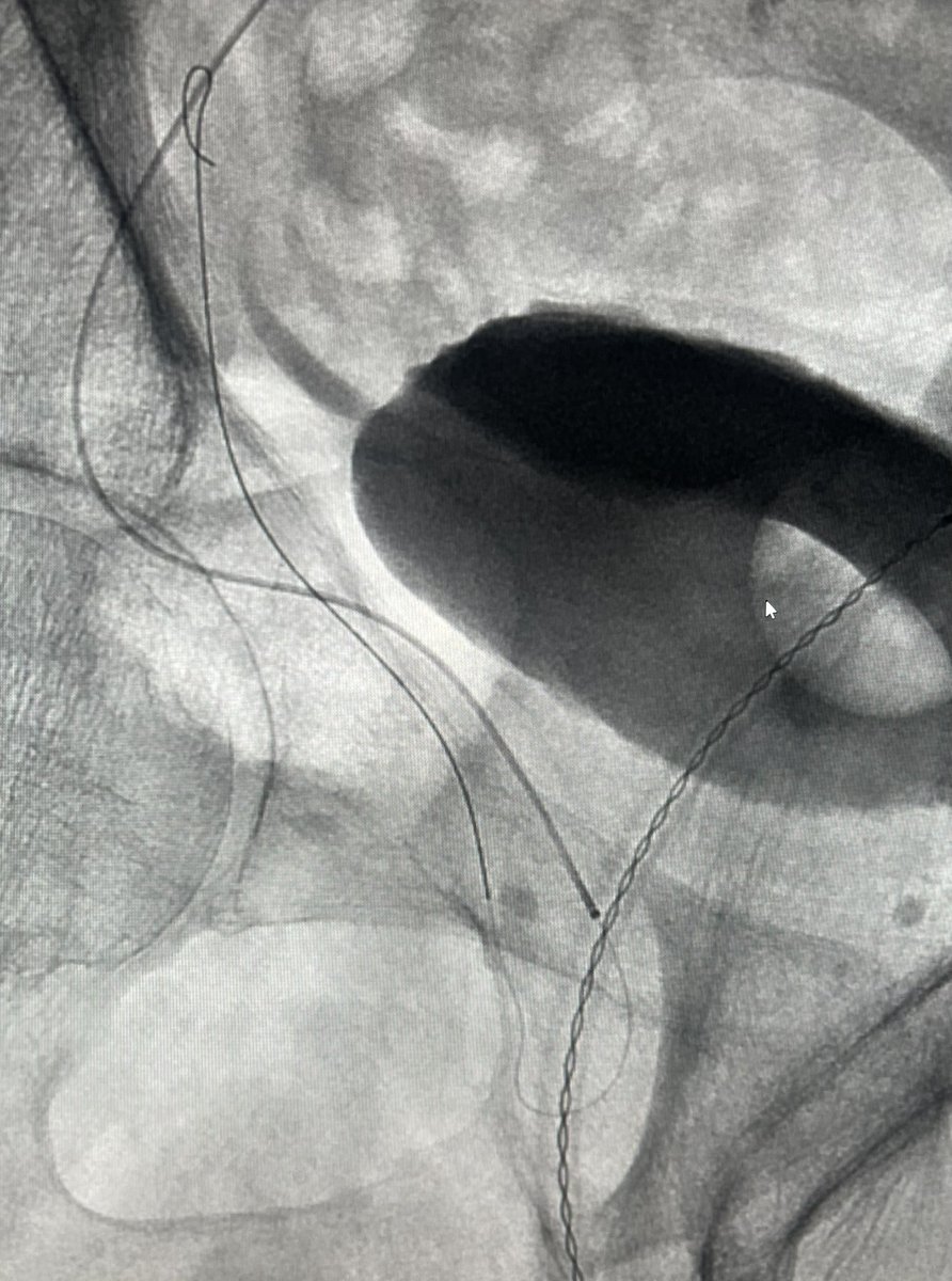 Ambarish Bhat (@bhat_ambarish) on Twitter photo Wire course during right #PAE.. what is the likely variant? <a href="/SIRRFS/">SIR RFS</a> <a href="/SIR_ECS/">SIR ECS</a> <a href="/SIRspecialists/">Society of Interventional Radiology</a> <a href="/ISVIRIndia/">ISVIR India</a> <a href="/CAIRweb/">Canadian Association for Interventional Radiology</a> <a href="/AriIsaacsonMD/">Ari Isaacson</a> <a href="/SandeepBaglaMD/">Sandeep Bagla MD</a> <a href="/UsaProstate/">Prostate Centers USA</a> <a href="/NaineshParikhMD/">Nainesh Parikh</a> <a href="/keithppereira/">Keith Pereira MD, #VIrad</a> <a href="/bonesz/">Aaron Fischman MD | Interventional Radiologist</a> Wire course during right #PAE.. what is the likely variant? <a href="/SIRRFS/">SIR RFS</a> <a href="/SIR_ECS/">SIR ECS</a> <a href="/SIRspecialists/">Society of Interventional Radiology</a> <a href="/ISVIRIndia/">ISVIR India</a> <a href="/CAIRweb/">Canadian Association for Interventional Radiology</a> <a href="/AriIsaacsonMD/">Ari Isaacson</a> <a href="/SandeepBaglaMD/">Sandeep Bagla MD</a> <a href="/UsaProstate/">Prostate Centers USA</a> <a href="/NaineshParikhMD/">Nainesh Parikh</a> <a href="/keithppereira/">Keith Pereira MD, #VIrad</a> <a href="/bonesz/">Aaron Fischman MD | Interventional Radiologist</a>