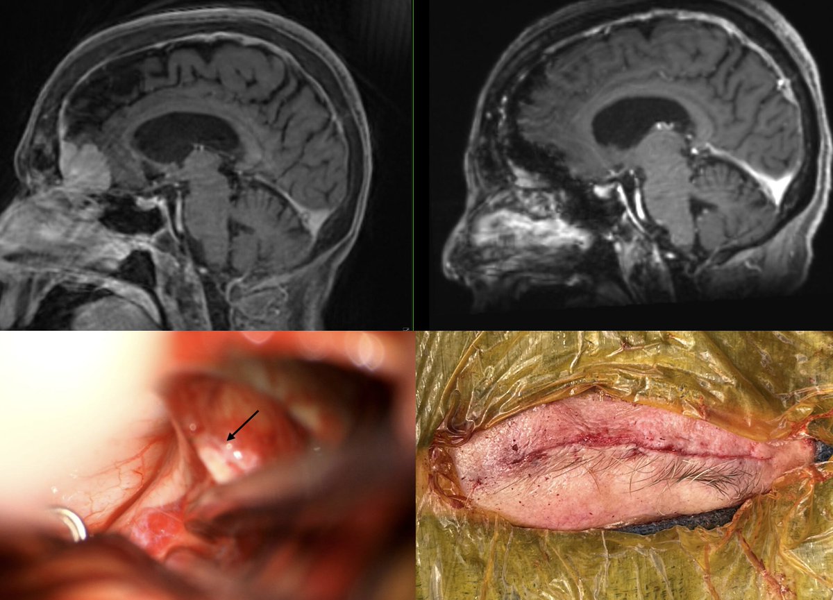 70s female with four year history of dementia and one week in coma. Left olfactory groove meningioma removed through eyebrow incision and supraorbital approach. Now awake and clearer.