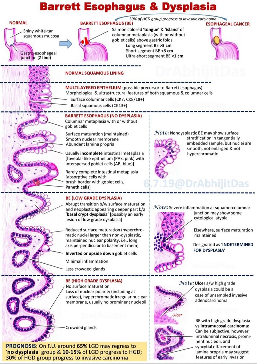 How to identify 'dysplasia categories' in a Barrett's esophagus and what is the significance?  
h/t <a href="/AbhijitSurgPath/">Abhijit Das, MD</a>
#BarrettEsophagus #gitwitter #GIpath #meded #medtwitter #INNOMed