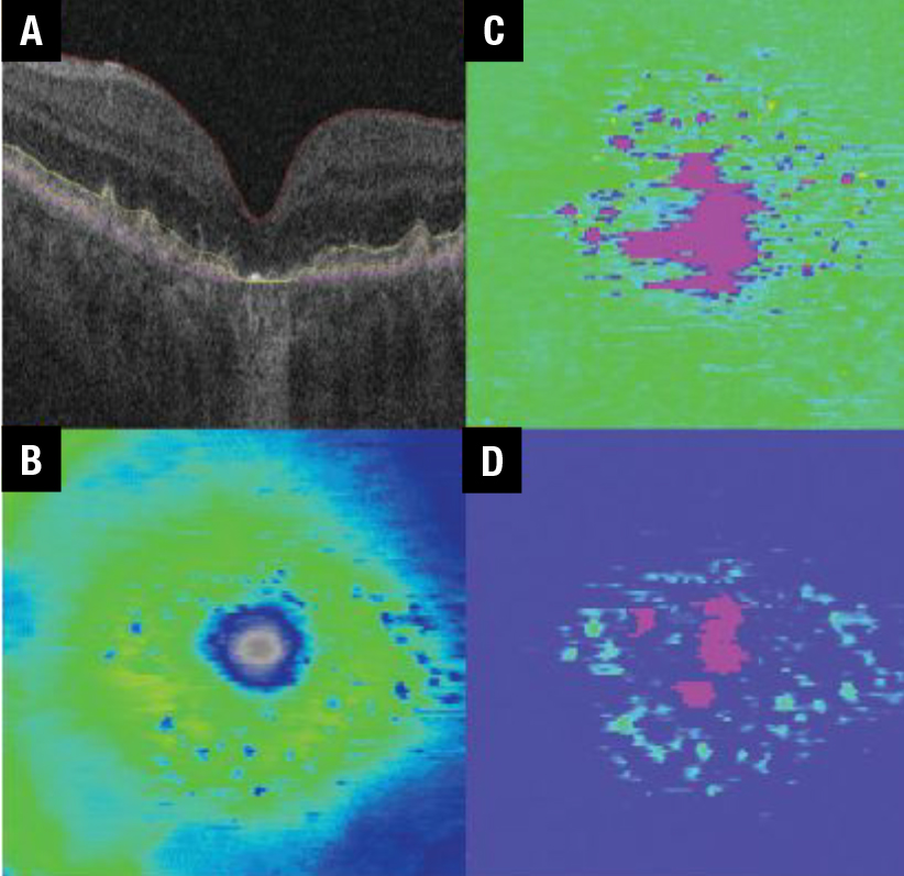 RevOphth's tweet photo. How AI may impact retinal practice 🖥 
Artificial intelligence has shown potential for helping us to manage the multitudes with geographic atrophy and diabetes.
https://t.co/0bn1aQytNj
#retina #retinaspecialist #retinaldisease #ophthalmology #ophthalmologist https://t.co/1cqPR9aBSm