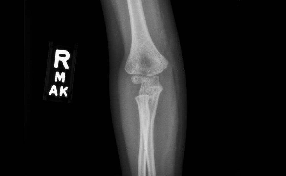 orthoEMpearls's tweet image. 4-year-old female presents with right arm pain. She fell onto an outstretched hand and immediately complained of severe pain. What’s the diagnosis?