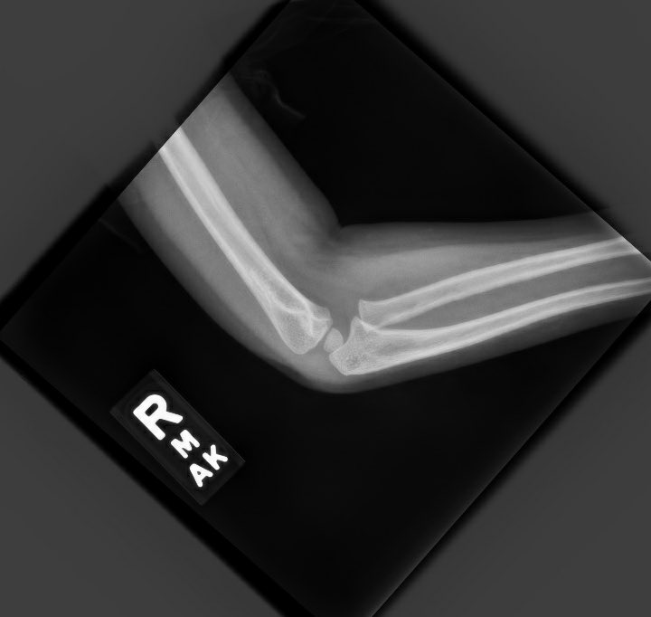 orthoEMpearls's tweet image. 4-year-old female presents with right arm pain. She fell onto an outstretched hand and immediately complained of severe pain. What’s the diagnosis?