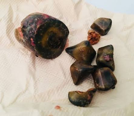 DrJyoti_S_PATEL's tweet photo. #Surgery #Cholelithiasis #relief #Hospital
Gallstones can sometimes cause problems by creating a blockage. This will cause pain and inflammation in your organs. If it goes untreated, it can cause serious complications.
#SurgeryDone โ๏ธ https://t.co/b63E1Xb7xj
