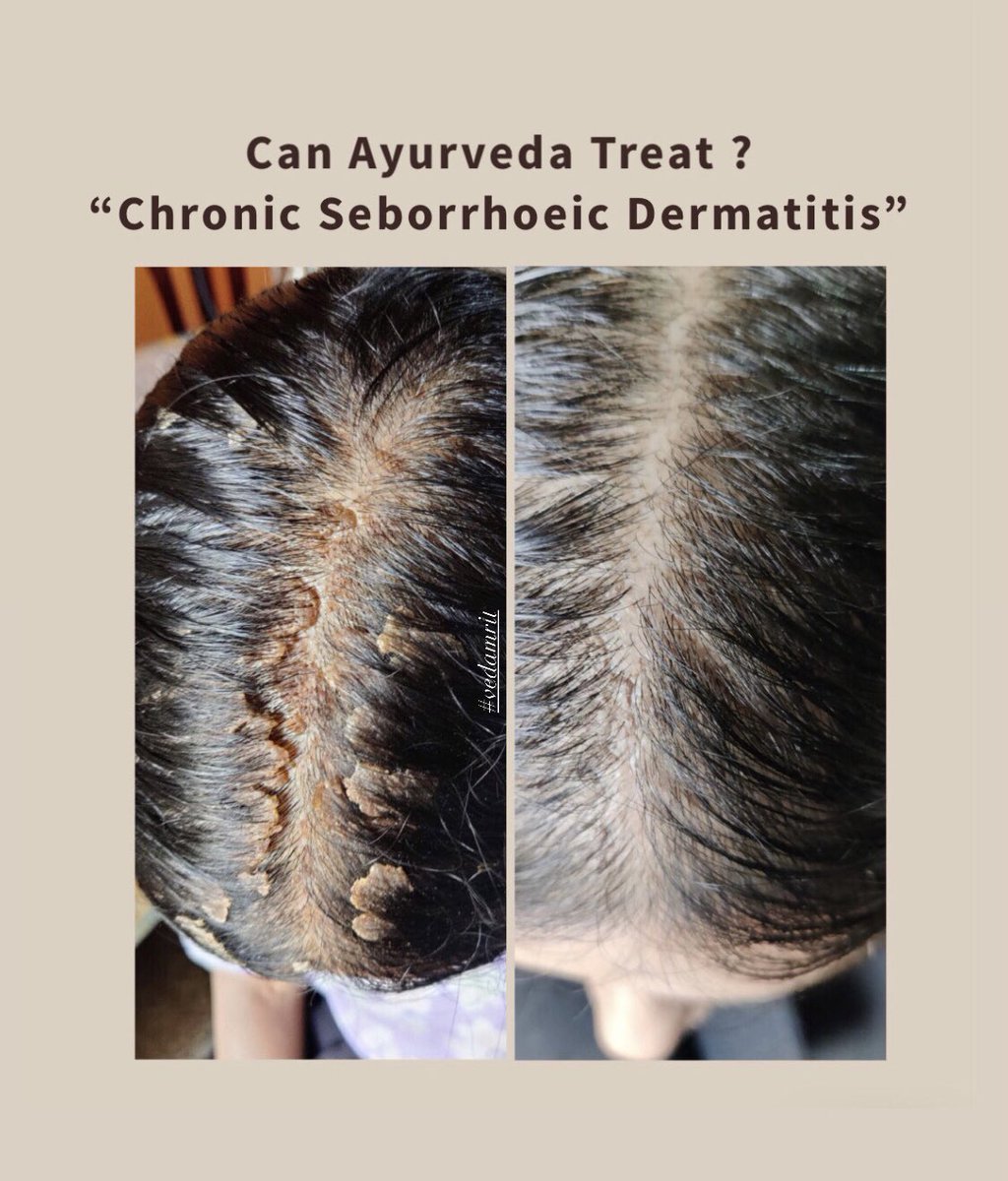 She thought of “Giving ayurveda a try” 
I guess this “try” was so “worth it” 

History - had already consumed steroids (on and off) for 13 months later was put on immunosuppressants saying it’s autoimmune condition and not treatable.

Ayurvedic skin treatment never disappoints ♥️