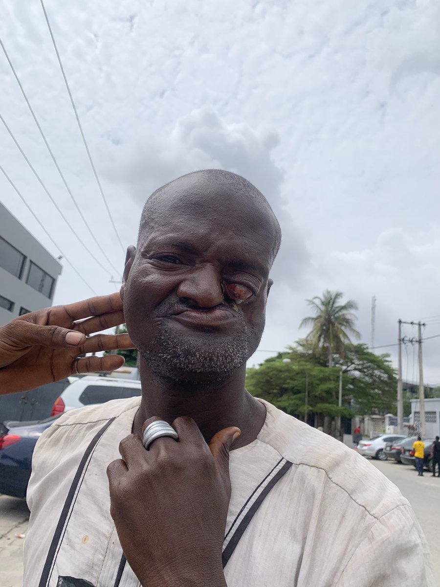 I met this man at a supermarket close to me. 
Every time I saw him, he looked worse and the mass in his eye was larger. I gave him some money to go to a federal hospital, to at least get seen by a specialist. 
I didn’t think he was going to go but I took the risk.
(Thread)