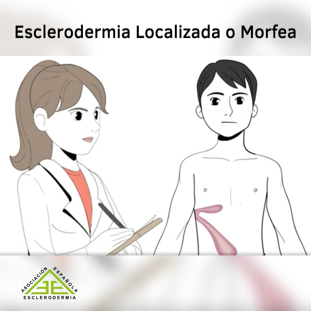 AEEsclerodermia's tweet photo. Ya puedes disfrutar en nuestro canal de Youtube un vídeo explicativo sobre la Esclerodermia Localizada o Morfea 👏
Colabora compartiendo este vídeo 🤝
Más información y contacto 👉 https://t.co/NsMf1HIg0d
Enlace del vídeo 🔗: https://t.co/7QacYebkgp
#morfea #esclerodermia https://t.co/H8Xgmq2Bdo