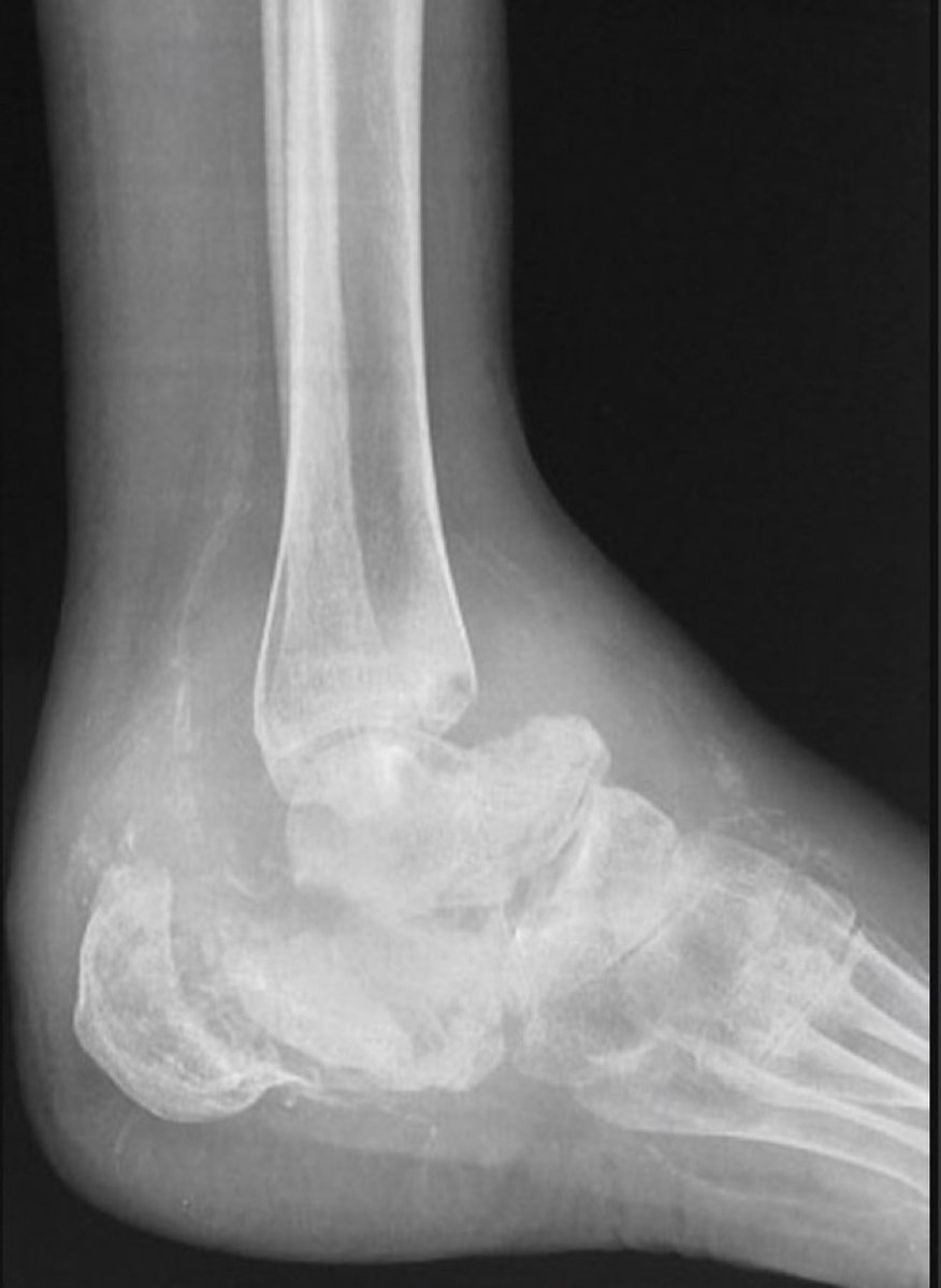 BrownJHM's tweet photo. A patient with uncontrolled diabetes presented with swelling and deformity of the foot. He reported having minimal pain and numbness. What is the likely diagnosis? H/t @DrCindyCooper #Medtwitter https://t.co/4RMvdeXNQm