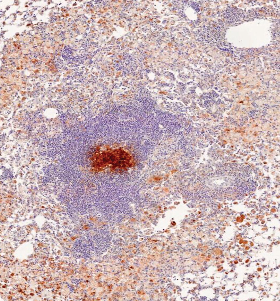 Katharina Ronacher (@ronacherk) on Twitter photo Absolutely honoured to have been awarded a #NHMRC grant as CIA valued at > $ 1.5 million to study the host determinants of granuloma formation and successful containment of #tuberculosis in the lung. <a href="/MaterResearch/">Mater Research</a> <a href="/UQMedicine/">UQ Medicine</a> <a href="/TRI_info/">Translational Research Institute</a> <a href="/UQ_News/">UQ News</a> Absolutely honoured to have been awarded a #NHMRC grant as CIA valued at > $ 1.5 million to study the host determinants of granuloma formation and successful containment of #tuberculosis in the lung. <a href="/MaterResearch/">Mater Research</a> <a href="/UQMedicine/">UQ Medicine</a> <a href="/TRI_info/">Translational Research Institute</a> <a href="/UQ_News/">UQ News</a>