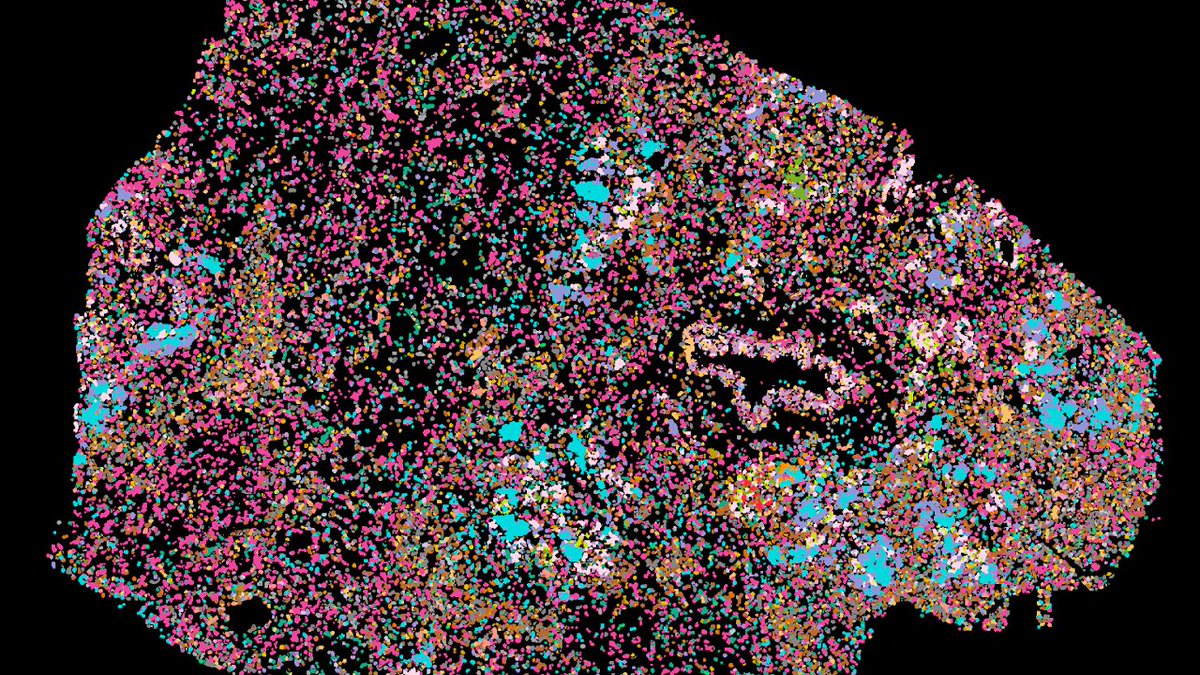 Are you looking for an opportunity to combine #singlecell #spatialtranscriptomics and clinical data? Join my new group in Computational Oncology at Charité as a PhD student! 💻🔬🩺 bit.ly/3FgnqLe Please RT and/or apply! #cancer #jobs @ChariteBerlin @berlinnovation