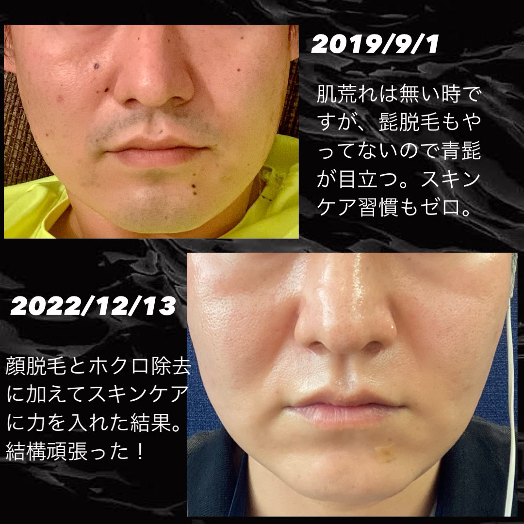 tk_hadakaizen's tweet photo. 30代後半男が肌改善を真剣に3年間取り組みました！
脱毛、ホクロ除去、セルフスキンケアを徹底しました！ダーマペンなど美容医療はまだ実践しておりません！結構頑張った！ https://t.co/gdSq5KRj7y