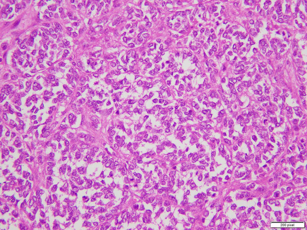 anam_t_khan's tweet photo. Young male presented with adrenal mass. No adrenal parenchyma identified. What is your diagnosis?
#PathTwitter @ChughtaiPathRes @chughtaidr @OmarChughtai https://t.co/iCT7wQxoMN
