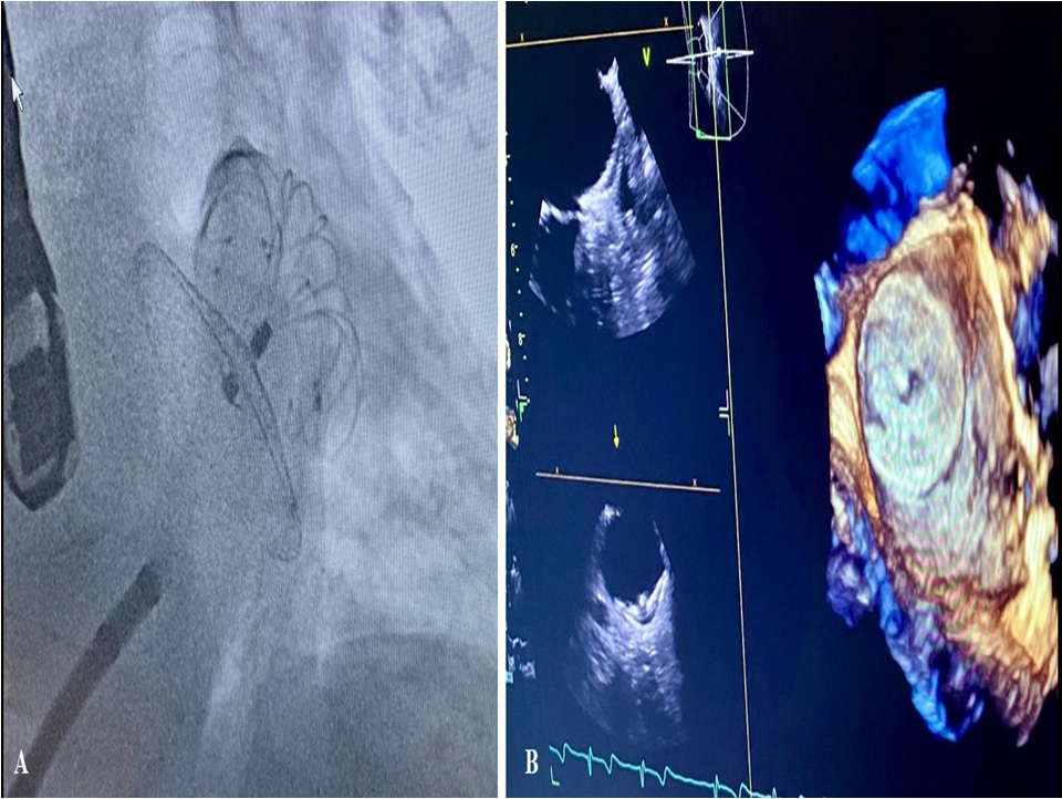RCMjournal's tweet photo. #RCM-Special Issue: Structural Heart Interventions (3/6)
🏆Left Atrial Appendage Closure: A Current Overview Focused on Technical Aspects and Different Approaches
@FGuarracini
#LeftAtrialAppendageClosure #AtrialFibrillation
Full Text:
https://t.co/0UJdT4hK8l https://t.co/aBlvB3AgFR