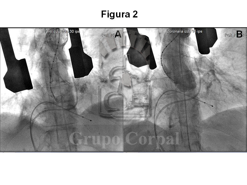 grupocorpal's tweet photo. Imágenes obtenidas durante la implantación de prótesis CoreValve en paciente con estenosis aórtica. ❤️ #cardiología #cardiologíaintervencionista #CoreValve
➜ https://t.co/FsR9eCOrCU https://t.co/O8N7FUDNFW