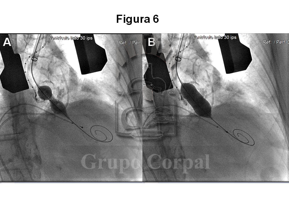grupocorpal's tweet photo. Imágenes obtenidas durante la implantación de prótesis CoreValve en paciente con estenosis aórtica. ❤️ #cardiología #cardiologíaintervencionista #CoreValve
➜ https://t.co/FsR9eCOrCU https://t.co/O8N7FUDNFW