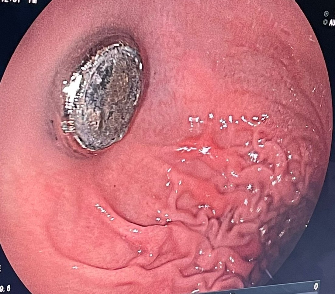 Tatisfc15's tweet photo. Lesión en mucosa gástrica por pila de botón, tras 12 horas de la ingesta. Es muy importante evitar que los niños tengan alcance a objetos pequeños que puedan ingerir. https://t.co/WWeBFTGdxQ