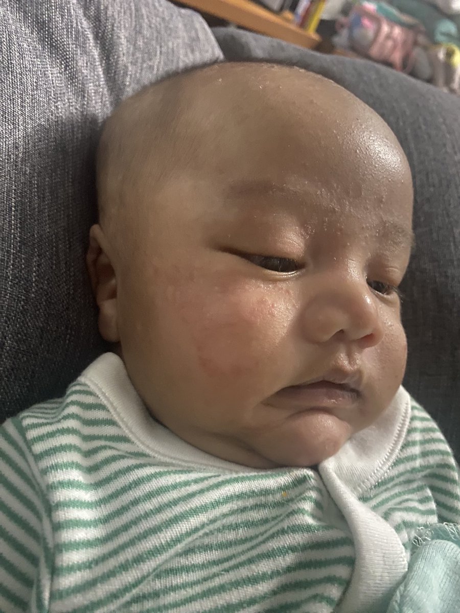 repunzeelll's tweet photo. please do not kiss a baby when its nt urs . Some fucking hooligan decided it was funny to kiss my son when i was nt looking and despite me wiping his face after, scars still appeared . The fuck is wrong with this people ? i know babies are cute , but when u kiss a newborn - https://t.co/5CNSslQZJN