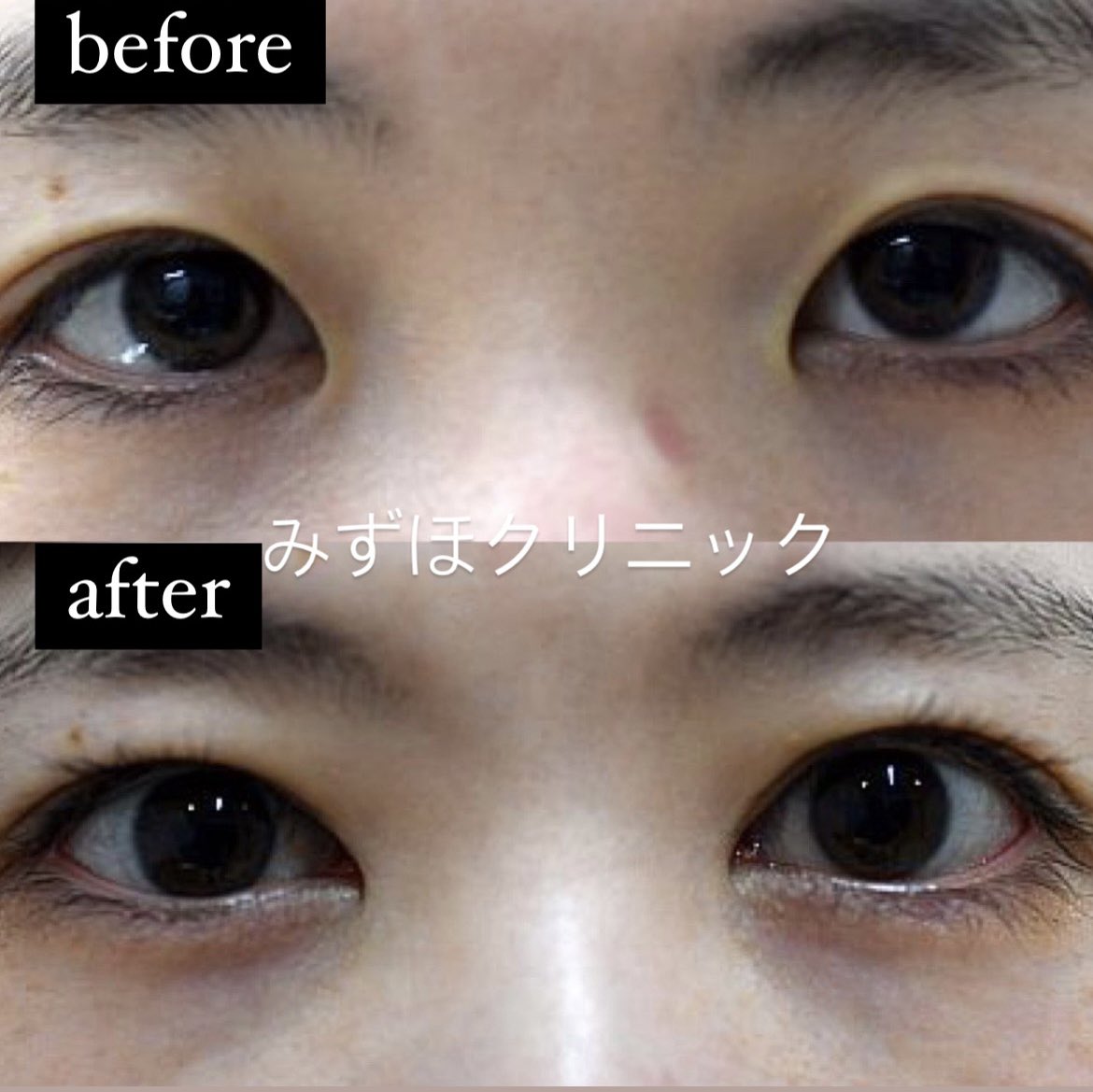 二重埋没法における失敗例 トラブルとその原因と解決法 池袋の美容皮膚科 美容外科なら みずほクリニック