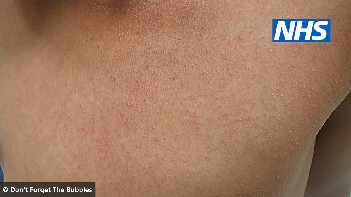 NHSuk's tweet image. Symptoms of scarlet fever are the same for children and adults, although scarlet fever is less common in adults.
 
The NHS website contains advice on what to look out for, how to treat the infection and how to reduce the chance of spreading it: nhs.uk/conditions/sca…