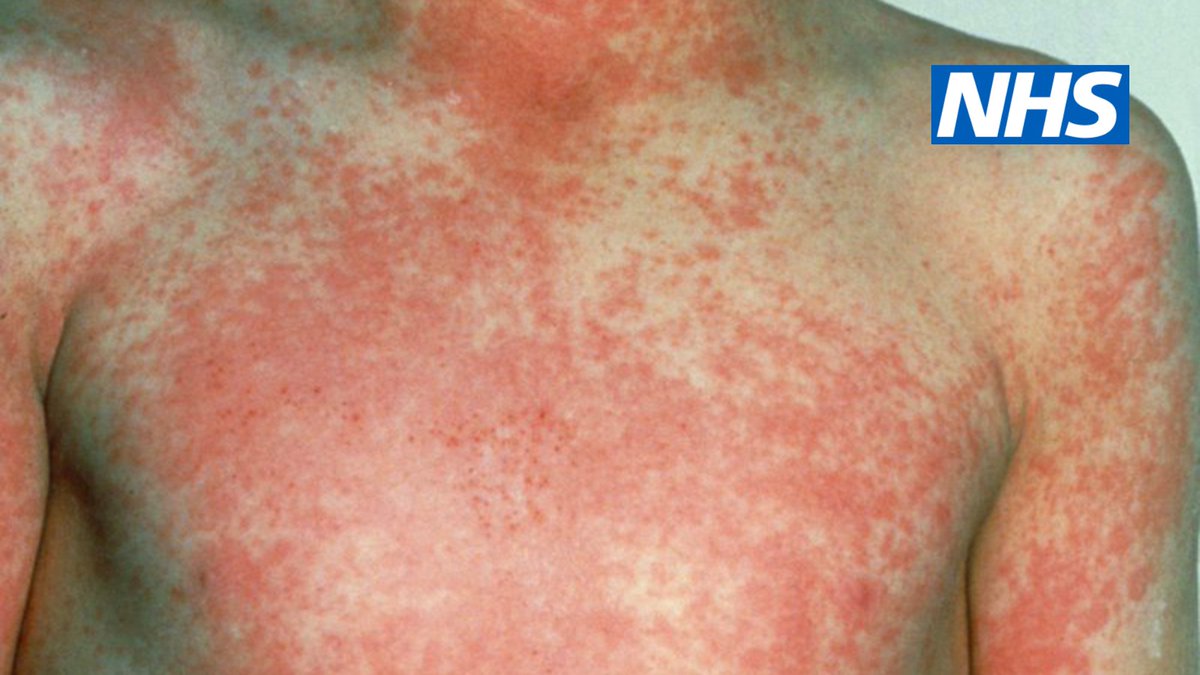 Symptoms of scarlet fever are the same for children and adults, although scarlet fever is less common in adults. The NHS website contains advice on what to look out for, how to treat the infection and how to reduce the chance of spreading it: nhs.uk/conditions/sca…