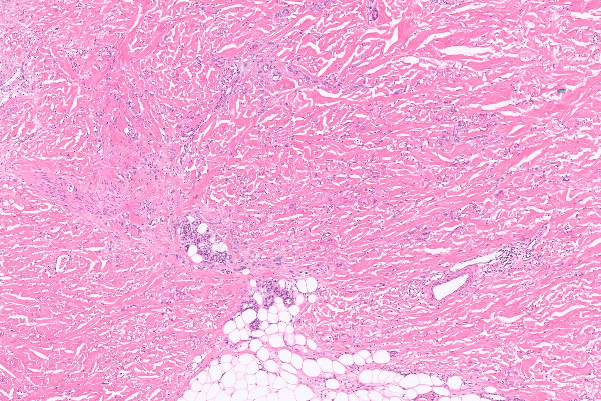 Middle-aged woman, breast. Multiple pathologies.
#pathology #pathtwitter #dermpath
Answer: kikoxp.com/posts/18521