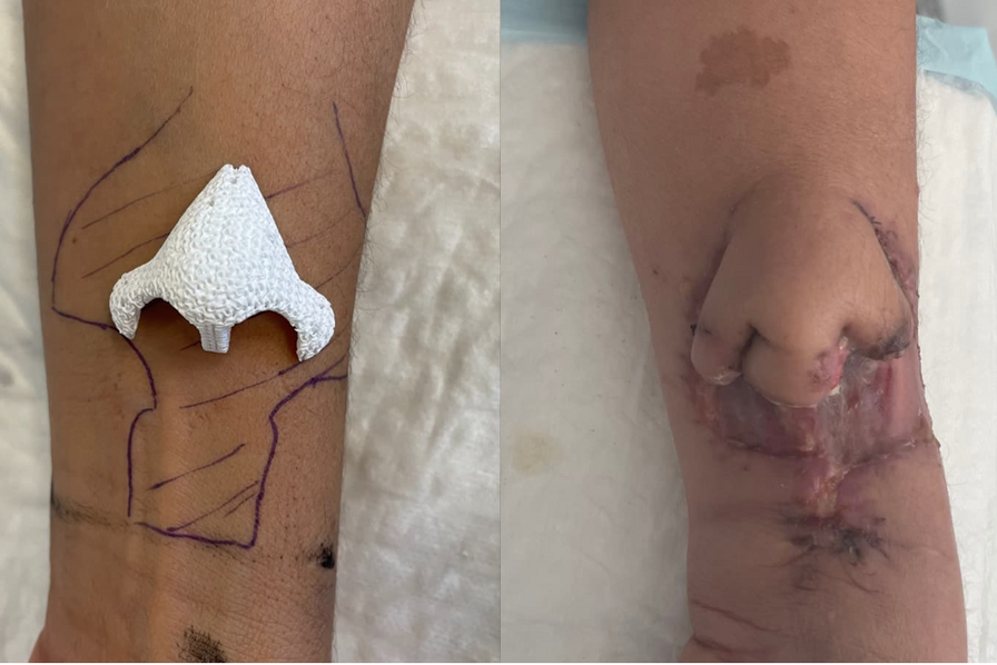 Une première mondiale !
Les équipes de chirurgie #ORL et Cervico-Faciale de l’<a href="/IUCTOncopole/">IUCT Oncopole</a> ont réalisé un exploit : la #greffe du #nez de Carine, après l’avoir reconstruit à l’aide d’une imprimante en 3D et implanté sur son bras.
corasso.org/.../un-nez-en-…