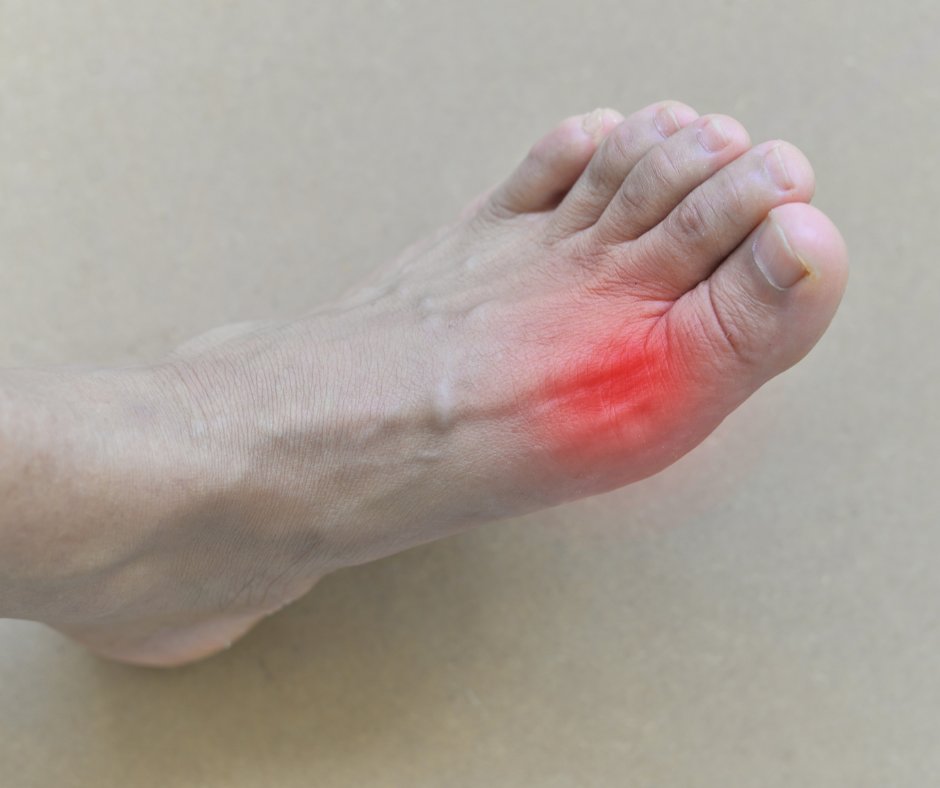 PodCenterNJ's tweet photo. Don't let gout get the best of you this holiday season. Reduce your chances of a #goutattack with the 5 tips in this week's blog. If you experience a gout flare-up, call #PodiatryCenterNJ at (973) 925-4111! https://t.co/8CnfOWA2DO
#Gout #GoutPain #WayneNJ https://t.co/7flyJ0USBz