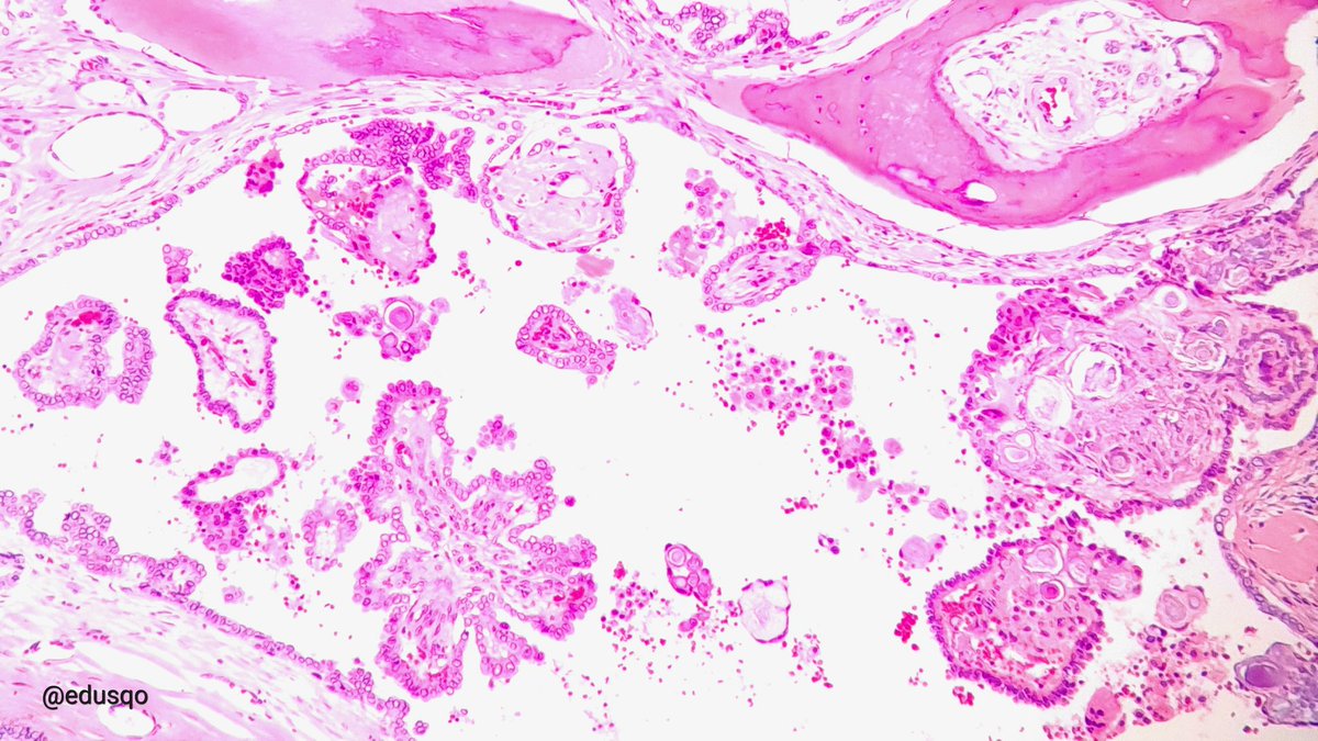 Crunchy texture while grossing the surgical specimen (some decalcification was necessary) - Papillary thyroid carcinoma with heterotopic ossification.
This bone formation has been associated with:
▫️Extrathyroidal extension
▫️Multifocality
▫️Lymph nodes
#EndoPath #PTC #GrossPath