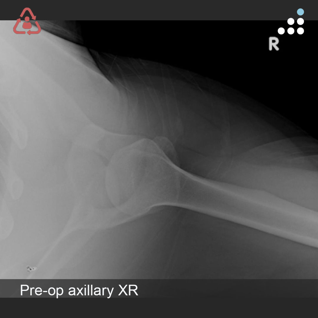 Orthobullets on Twitter "Here’s a new case by Dr. Ben Sharareh