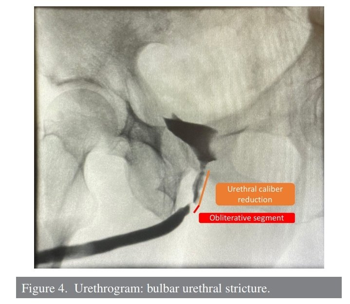 TurkJUrol's tweet photo. Artificial Urinary Sphincter in a High-Risk Urethra: Transcorporal Gullwing Modification Description of the Technique
David Hernández-Hernández et al.
#Artificialurinarysphincter #stressurinaryincontinence #reoperation #revisionsurgery
Article Link:
https://t.co/aZht06Osn3 https://t.co/EB5mbkuhz6