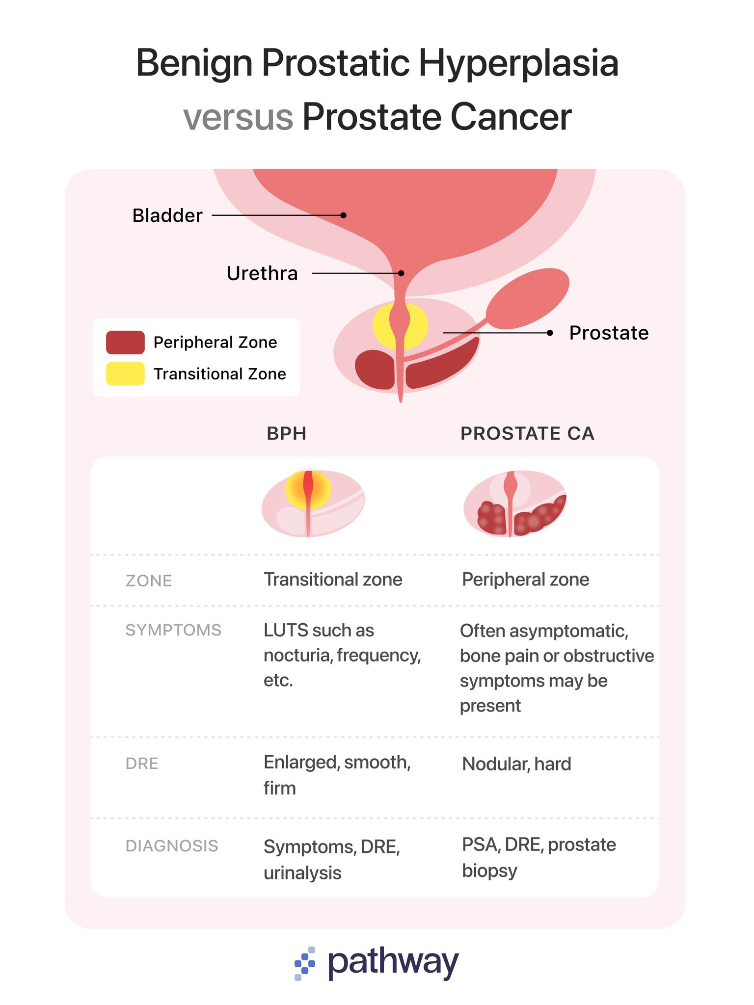 Pathway On Twitter BPH Vs Prostate Cancer Anatomy Symptoms And pathway-on-twitter-bph-vs-prostate-cancer-anatomy-symptoms-and