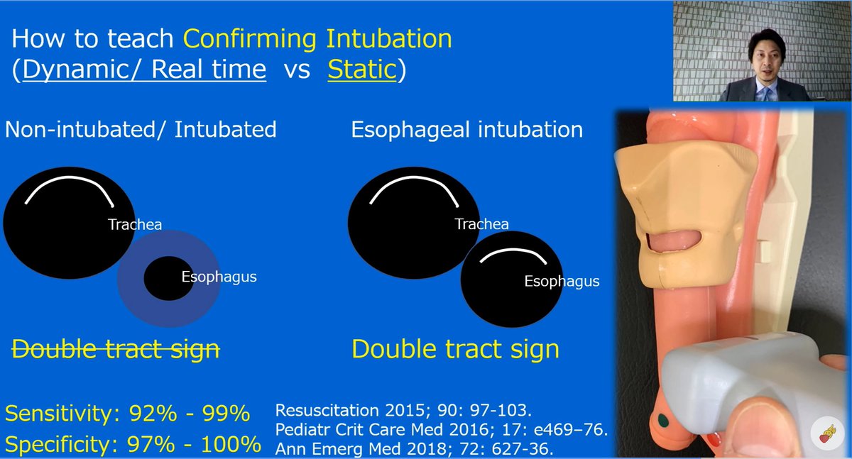 Airway ultrasound for ETT confirmation from our Japanese colleagues #WINFOCUS22 #EACEM22 

Qns - colleagues who use this, is it replacing capnography?