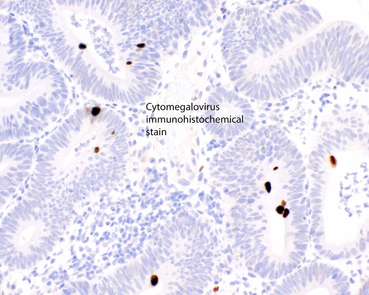 LizMontgomeryMD's tweet photo. This colonic tubular adenoma managed to catch cytomegalovirus. https://t.co/jl3n32a5Fk