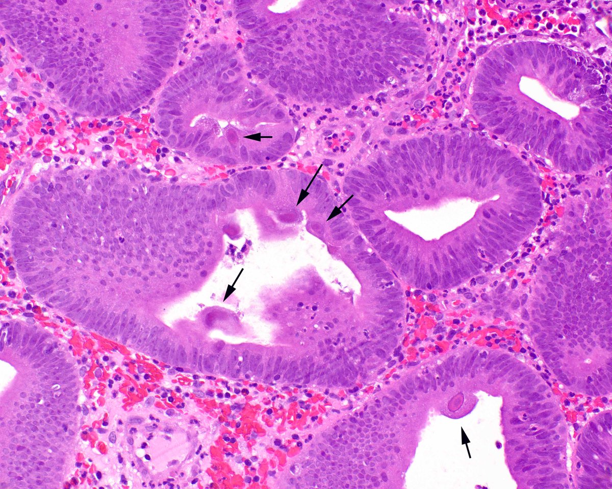 LizMontgomeryMD's tweet photo. This colonic tubular adenoma managed to catch cytomegalovirus. https://t.co/jl3n32a5Fk
