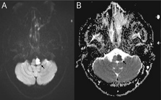 tychicuschen's tweet photo. What do you get when you add a Wallenberg (lateral medullary) to a Dejerine (medial medullary) syndrome? 🧐

Teaching Neuroimage: Reinhold's Hemimedullary Syndrome @GreenJournal #NeuroTwitter 
https://t.co/kggsDnD7RA https://t.co/Epm2cWMCEV