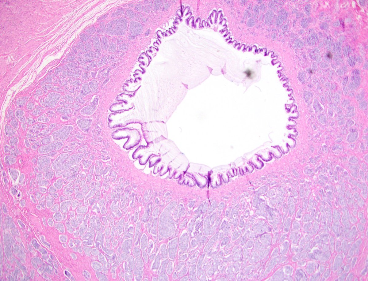 An appendiceal  twofer! LAMN  and  carcinoid  (oh come  on, what  the harm!).  #GIpath PS a  case from Dr. Yilmaz