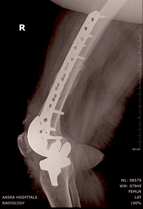 An elderly lady closely related to me had severe osteoporosis of knees.

We did TKR for both her kne...