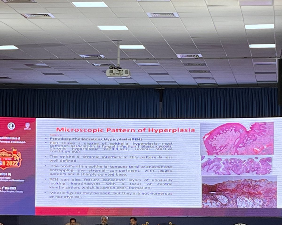 Psuedoepitheliomatous Hyperplasia has always been a confusing entity for me!! Thank you Dr. Usha sharma maam for clarifying it so well!!
<a href="/DrNithyashree/">Dr NithYASHree</a> <a href="/archibhat3/">Archana bhat</a> <a href="/DrRamaswamyAS/">Dr Ramaswamy AS MD</a> <a href="/suraksharaob/">Dr. Suraksha.Rao B</a> <a href="/VijayPatho/">Vijay Shankar S</a> <a href="/DrAbdusSamee/">Abdus Samee, MD</a> <a href="/NippoPaul/">Nithin Paul NipPO</a> <a href="/Swathiprabhu5/">Swathi Prabhu, MD</a> <a href="/adi_agnihotri/">Aditya Agnihotri 🇮🇳</a> <a href="/kciapm/">Karnataka Chapter-IAPM (KCIAPM)</a> #APCON2022