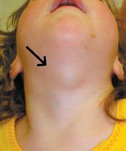 Neck surgery was done for ? https://t.co/Fx9Bjpda4Y