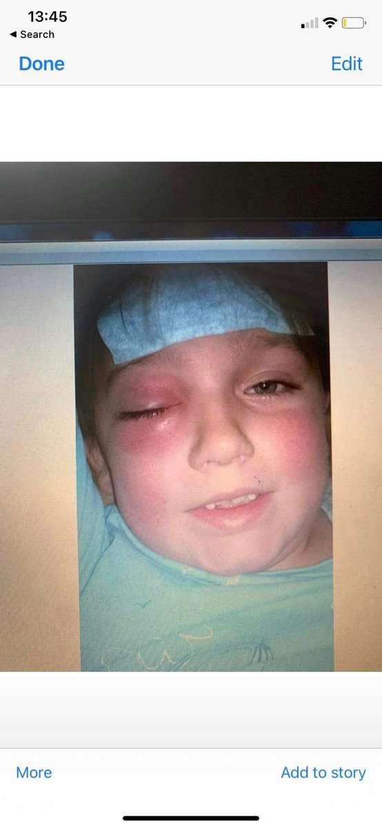 In 2014 my daughter was in hospital with periorbital cellulitis caused by iGAS #StrepA. It was Boxing Day, it started off looking like conjunctivitis but she had a severe headache &amp; temp. The abx didn’t work quickly enough, she had an op to drain the abscess - Awareness is 🔑
