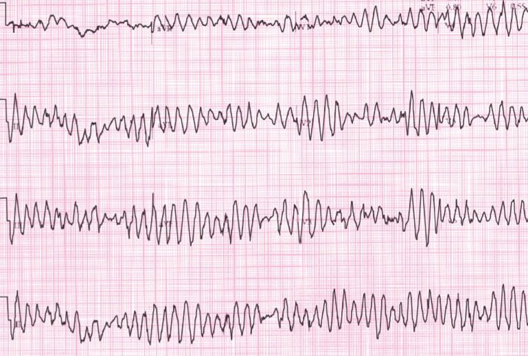 Does Low Magnesium Cause Muscle Pain