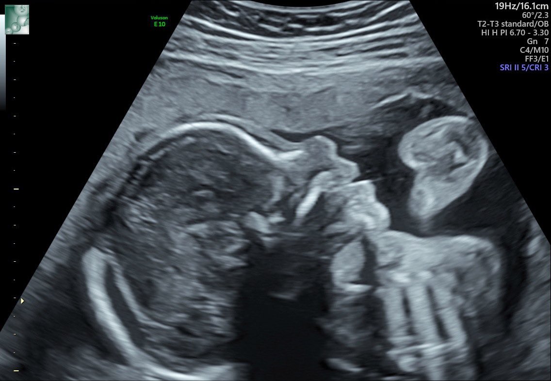 Pas l’habitude de parler de privé ici, mais je suis heureux de vous annoncer que ma compagne et moi allons devenir parent dans 3 mois. 

Après un long combat de plusieurs années contre l’endométriose, petit message d’espoir il faut toujours y croire. 

Bonheur Immense. ❤️